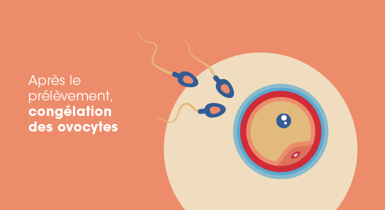 illustration sur la congélation des ovocytes 